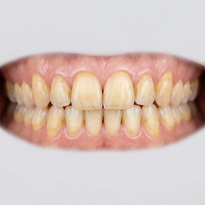 Antes: dientes amarillentos y manchados [lr:1o8vrx6]