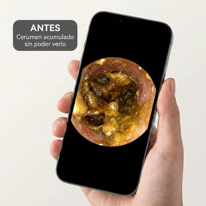 Antes: cerumen acumulado sin poder verlo